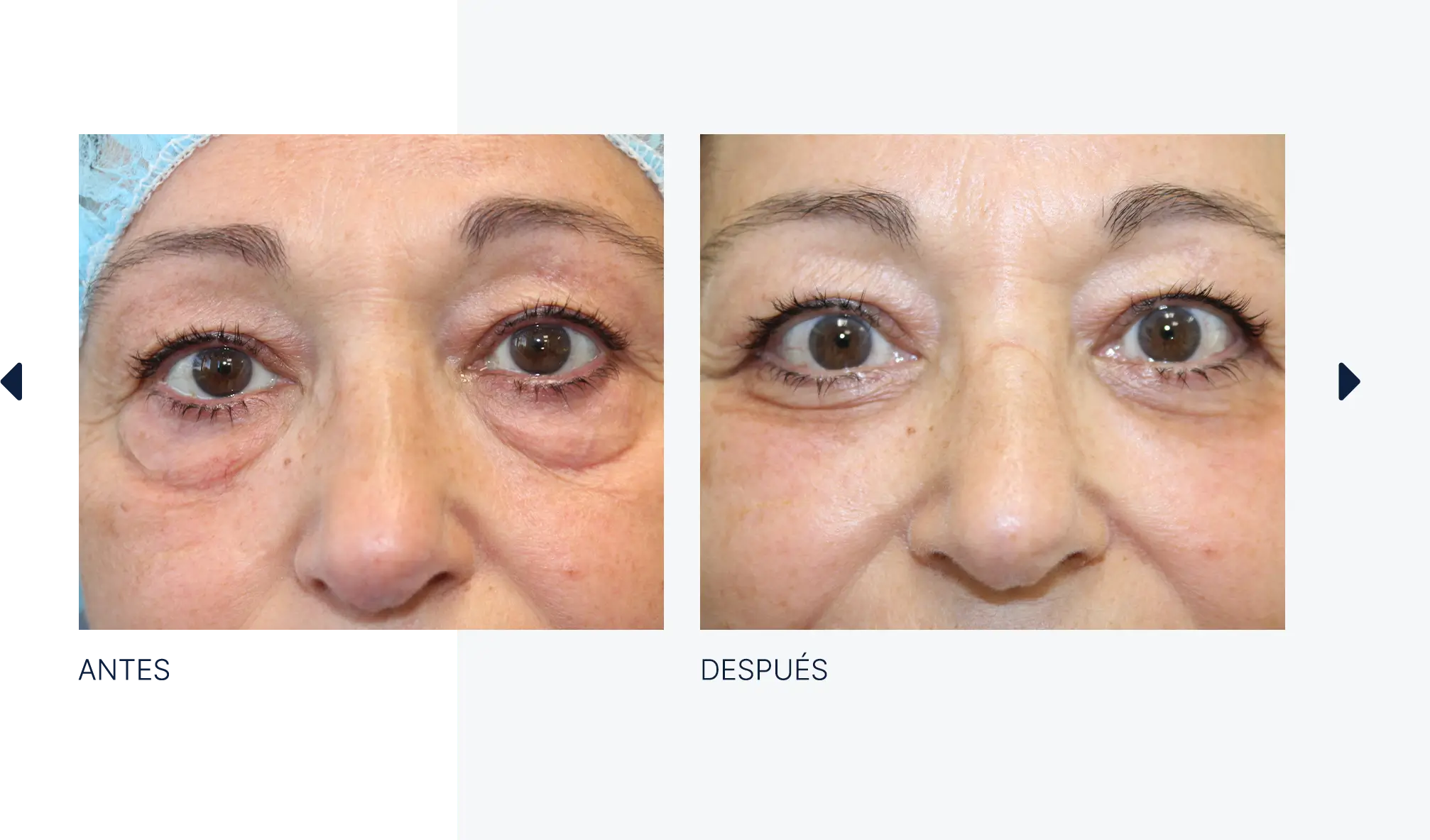 img-antes-despues-05