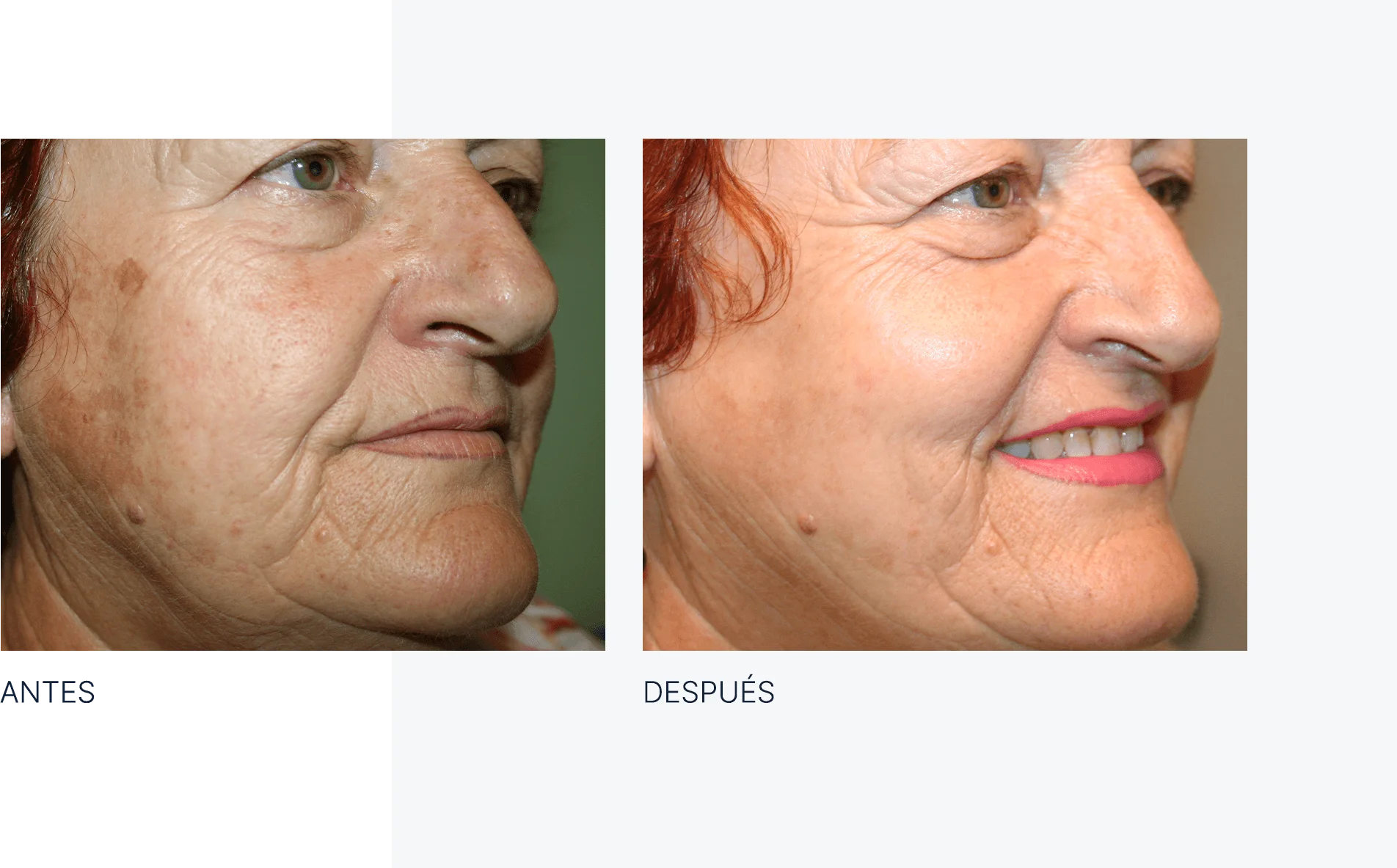 img-antes-despues-ipl-01