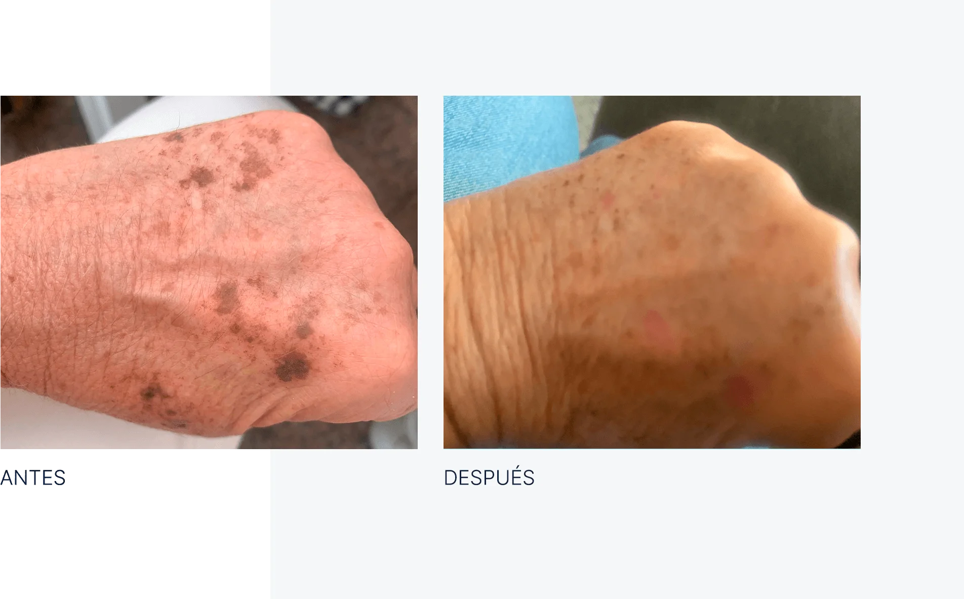 img-antes-despues-ipl-02