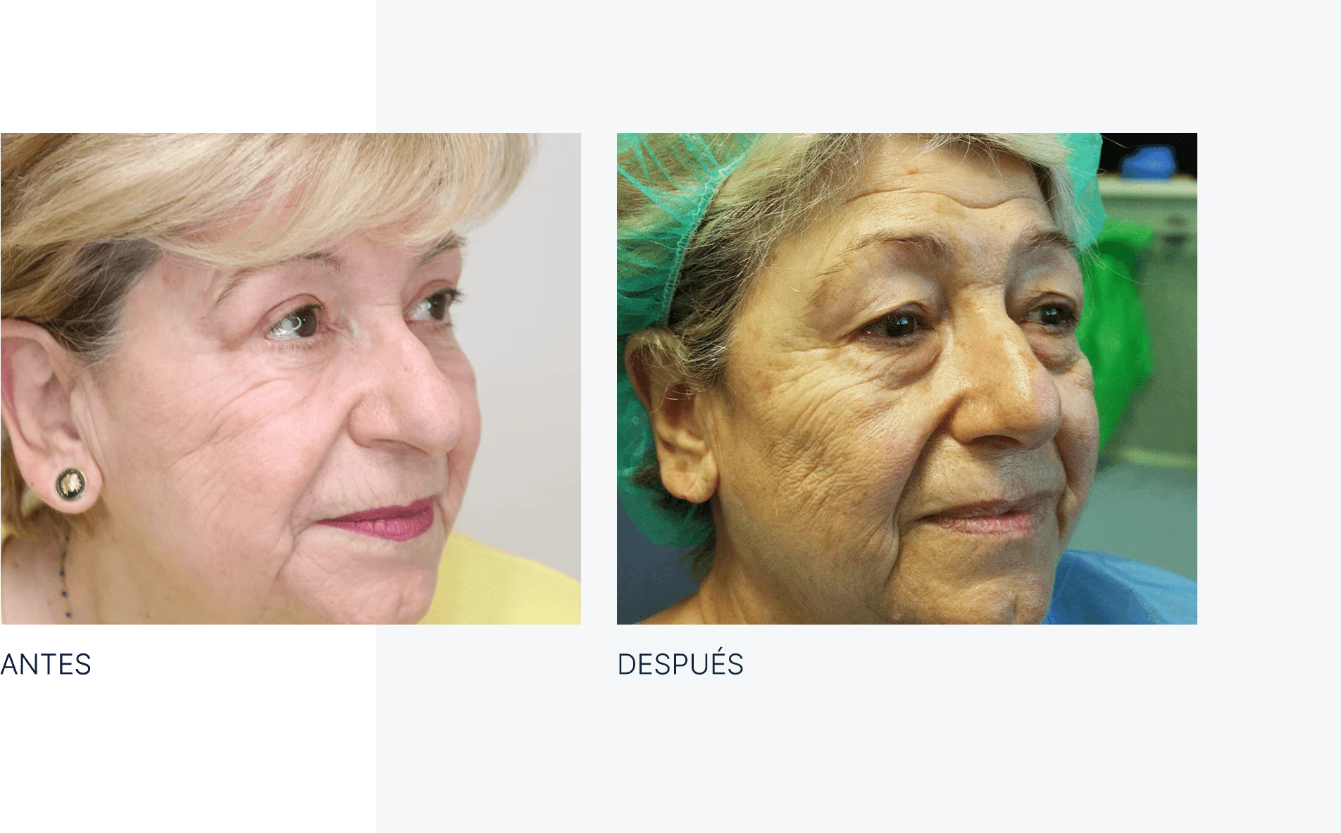img-antes-despues-laser-co2-acupulse