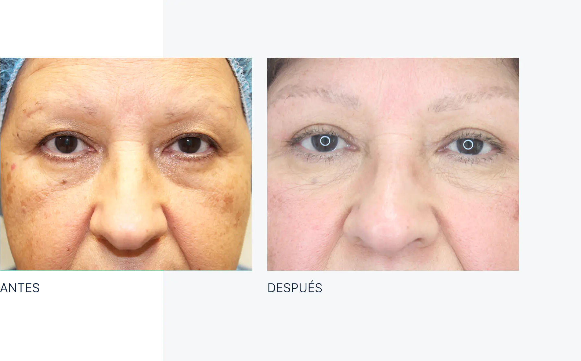 img-antes-despues-ojeras-manchas-01