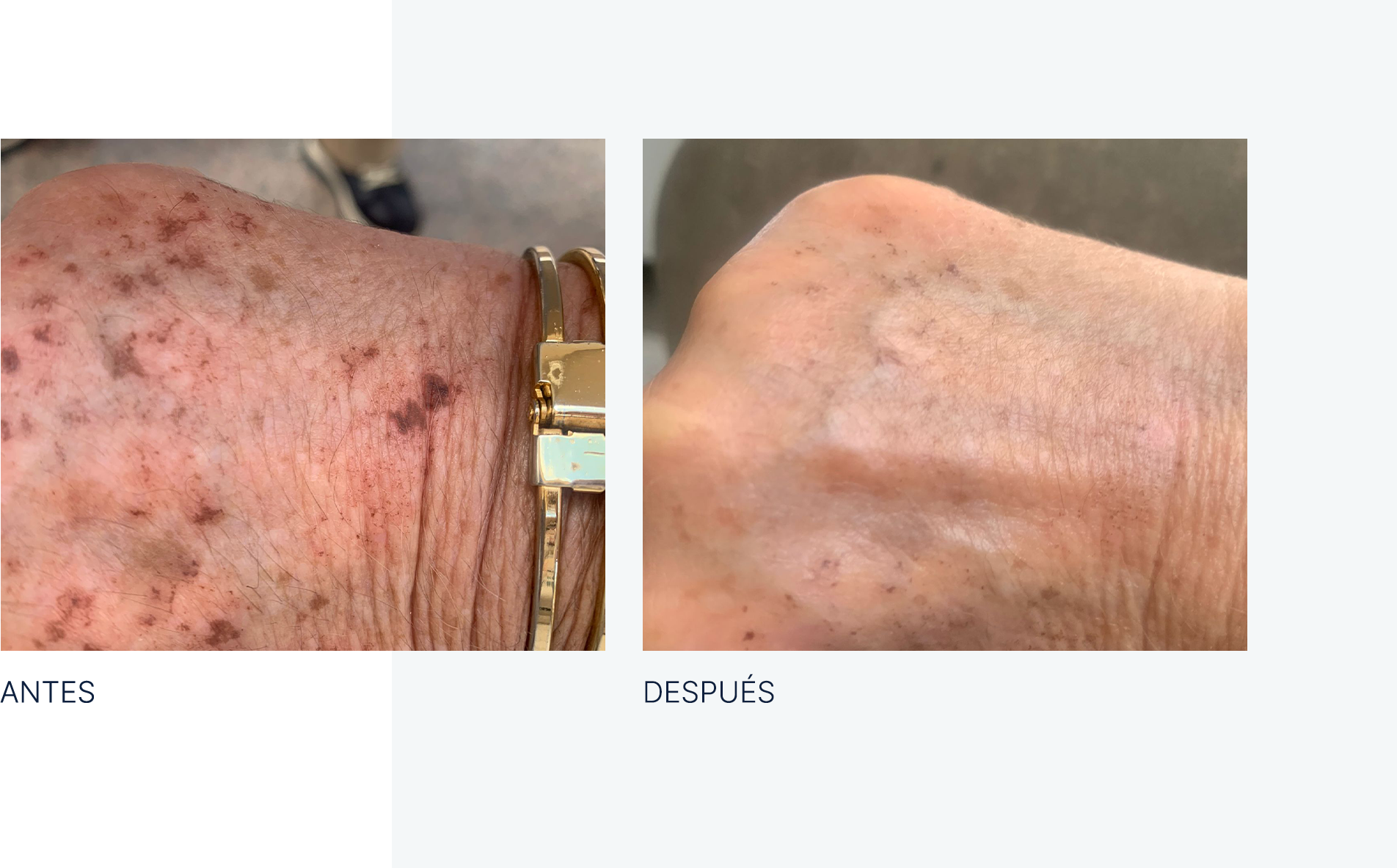 img-antes-despues-ojeras-manchas-02