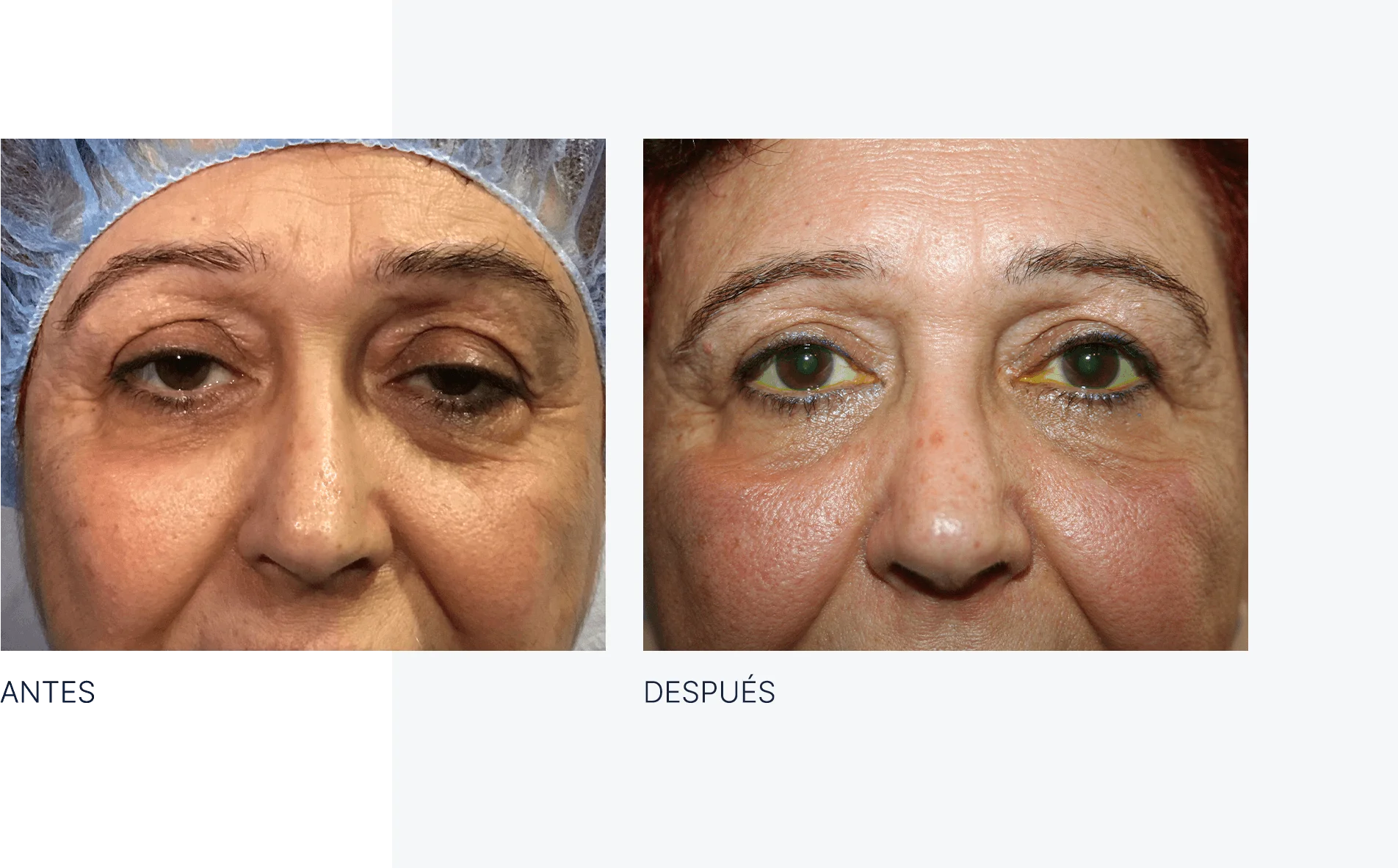 img-antes-despues-ptosis-01