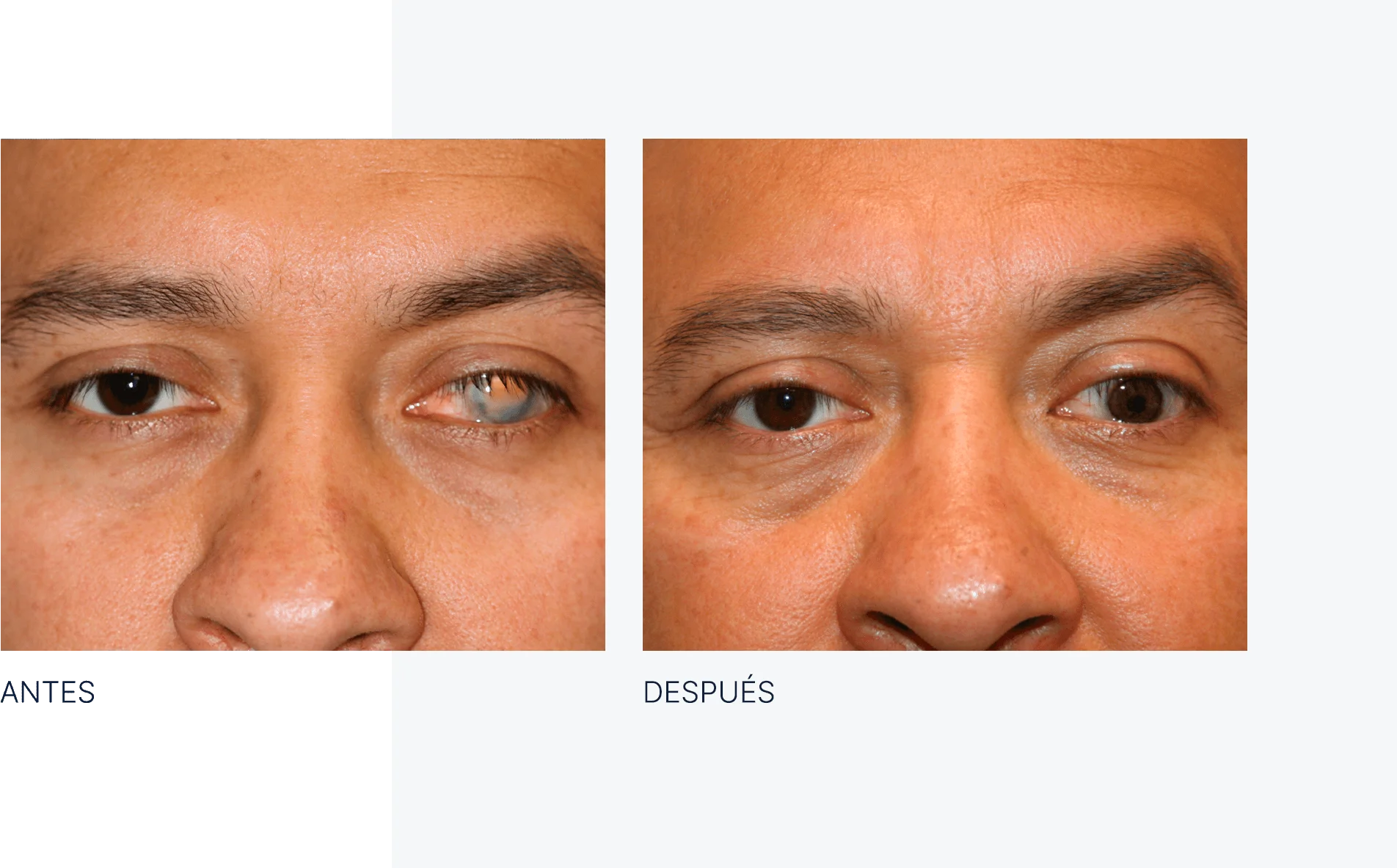 img-antes-despues-reconstruccion-ocular-02